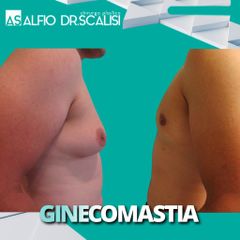 Ginecomastia - Dott. ALFIO SCALISI - 4 Spa Medical Clinic