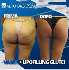 Gluteoplastica - Dott. ALFIO SCALISI - 4 Spa Medical Clinic