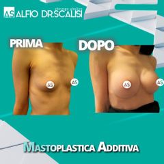 Mastoplastica additiva - Dott. ALFIO SCALISI - 4 Spa Medical Clinic