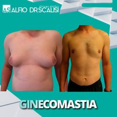Ginecomastia - Dott. ALFIO SCALISI - 4 Spa Medical Clinic
