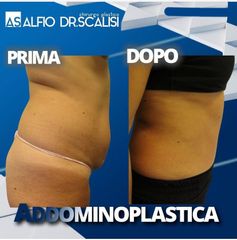 Addominoplastica - Dott. ALFIO SCALISI - 4 Spa Medical Clinic