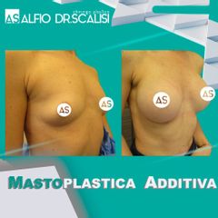 Mastoplastica additiva - Dott. ALFIO SCALISI - 4 Spa Medical Clinic
