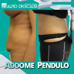 Addominoplastica - Dott. ALFIO SCALISI - 4 Spa Medical Clinic