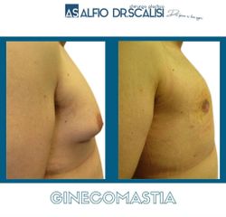 Ginecomastia - Dott. ALFIO SCALISI - 4 Spa Medical Clinic