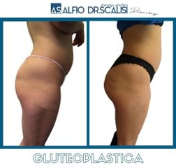 Gluteoplastica - Dott. ALFIO SCALISI - 4 Spa Medical Clinic