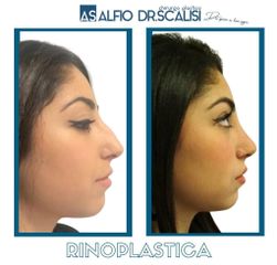 Rinoplastica - Dott. ALFIO SCALISI - 4 Spa Medical Clinic