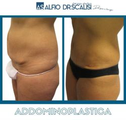 Addominoplastica - Dott. ALFIO SCALISI - 4 Spa Medical Clinic