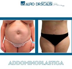 Addominoplastica - Dott. ALFIO SCALISI - 4 Spa Medical Clinic