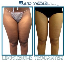 Liposuzione trocanteri - Dott. ALFIO SCALISI - 4 Spa Medical Clinic