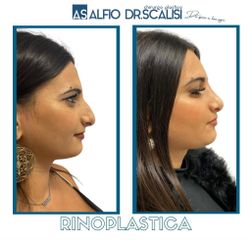 Rinoplastica - Dott. ALFIO SCALISI - 4 Spa Medical Clinic