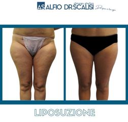 Liposuzione - Dott. ALFIO SCALISI - 4 Spa Medical Clinic