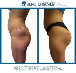 Gluteoplastica - Dott. ALFIO SCALISI - 4 Spa Medical Clinic