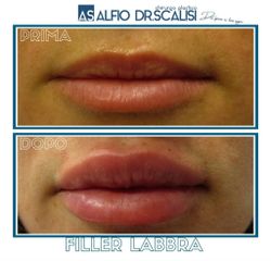 Filler labbra - Dott. ALFIO SCALISI - 4 Spa Medical Clinic