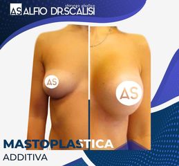 Mastoplastica additiva - Dott. ALFIO SCALISI - 4 Spa Medical Clinic