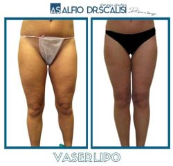 Vaserlipo - Dott. ALFIO SCALISI - 4 Spa Medical Clinic