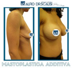 Mastoplastica additiva - Dott. ALFIO SCALISI - 4 Spa Medical Clinic