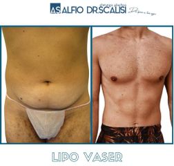 Lipo vaser - Dott. ALFIO SCALISI - 4 Spa Medical Clinic