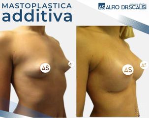 Dott. Alfio Scalisi - 4 Spa Medical Clinic Mastoplastica Additiva