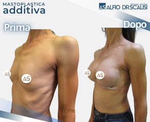 Dott. Alfio Scalisi - 4 Spa Medical Clinic Mastoplastica Additiva
