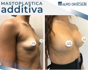 Dott. Alfio Scalisi - 4 Spa Medical Clinic Mastoplastica Additiva