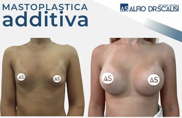 Dott. Alfio Scalisi - 4 Spa Medical Clinic Mastoplastica Additiva