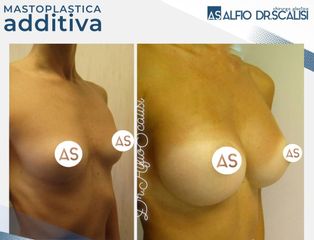 Dott. Alfio Scalisi - 4 Spa Medical Clinic Mastoplastica Additiva