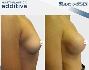 Dott. Alfio Scalisi - 4 Spa Medical Clinic Mastoplastica Additiva