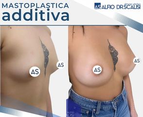 Dott. Alfio Scalisi - 4 Spa Medical Clinic Mastoplastica Additiva