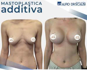 Dott. Alfio Scalisi - 4 Spa Medical Clinic Mastoplastica Additiva