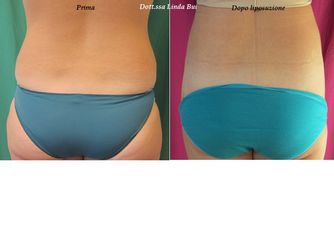 Liposuzione prima e dopo