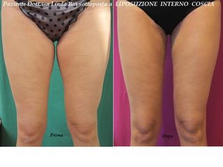 Liposuzione prima e dopo