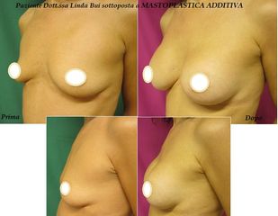 Mastoplastica additiva prima e dopo