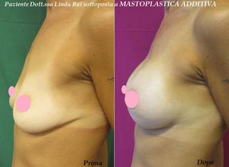 Mastoplastica additiva prima e dopo