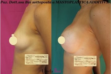 Mastoplastica additiva prima e dopo