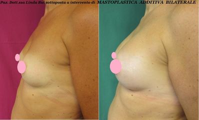 Mastoplastica additiva prima e dopo