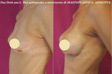 Mastoplastica additiva prima e dopo
