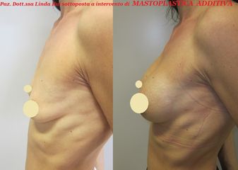 Mastoplastica additiva prima e dopo