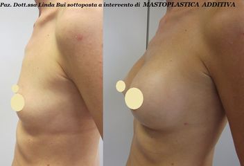 Mastoplastica additiva prima e dopo