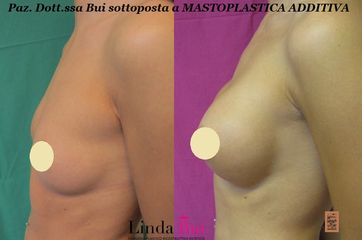 Mastoplastica additiva prima e dopo
