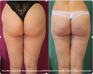 Liposuzione prima e dopo