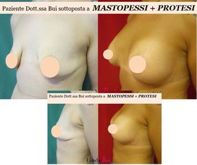 Mastopessi prima e dopo