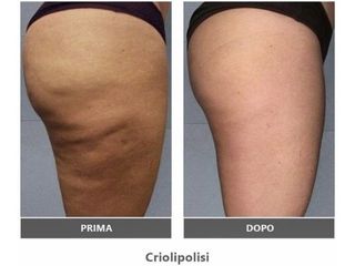 Criolipolisi - Dott. Roberto Lualdi