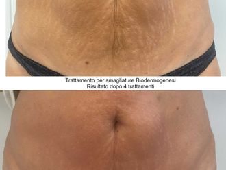 Smagliature prima e dopo - 837221