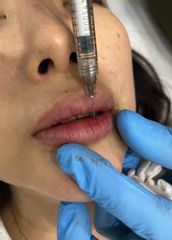 filler labbra - Dott. Roberto Lualdi