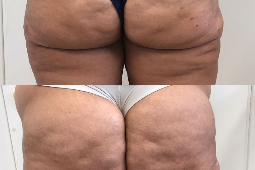 Mesoterapia prima e dopo - 852216