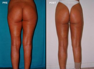 Liposcultura prima e dopo