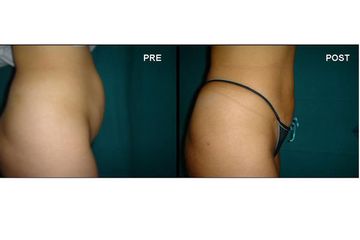 Lipoaspirazione prima e dopo