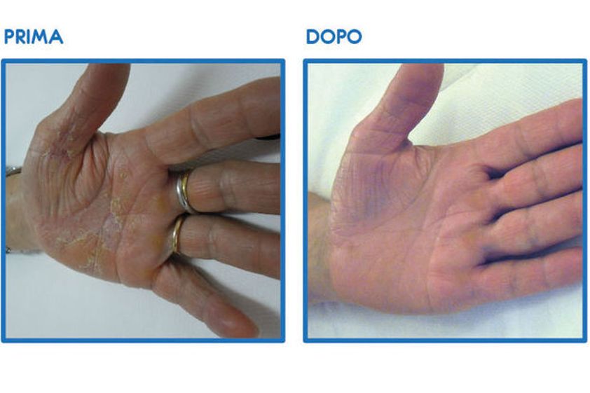 Psoriasi prima e dopo - 752626