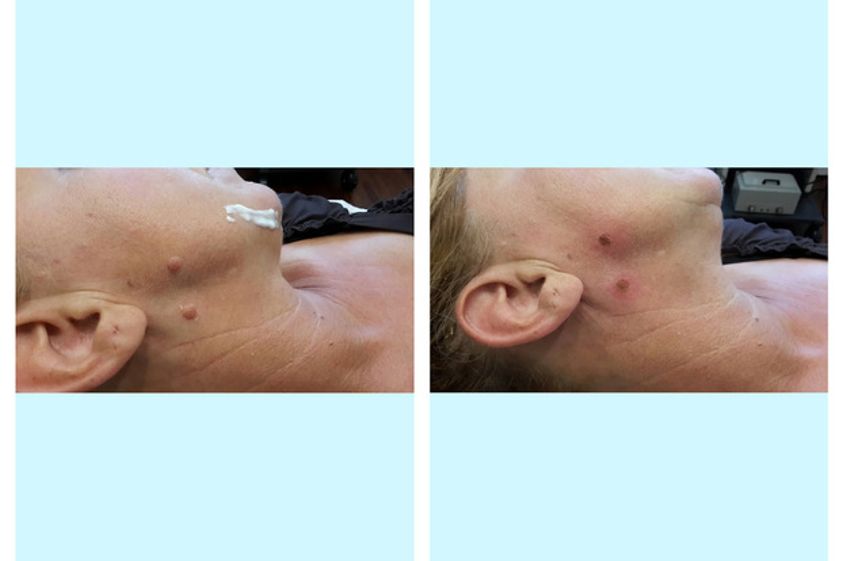 Laserterapia prima e dopo - 752811