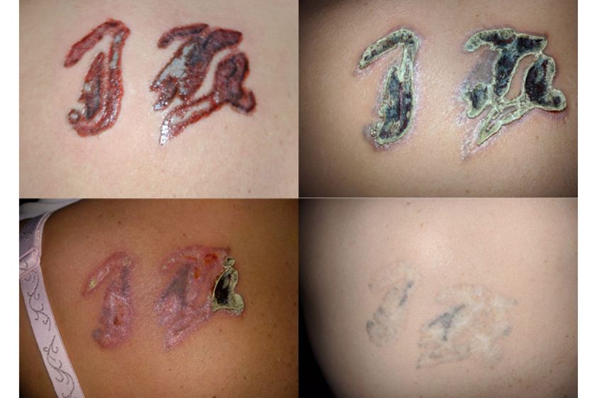 Rimozione tatuaggi prima e dopo - 768744